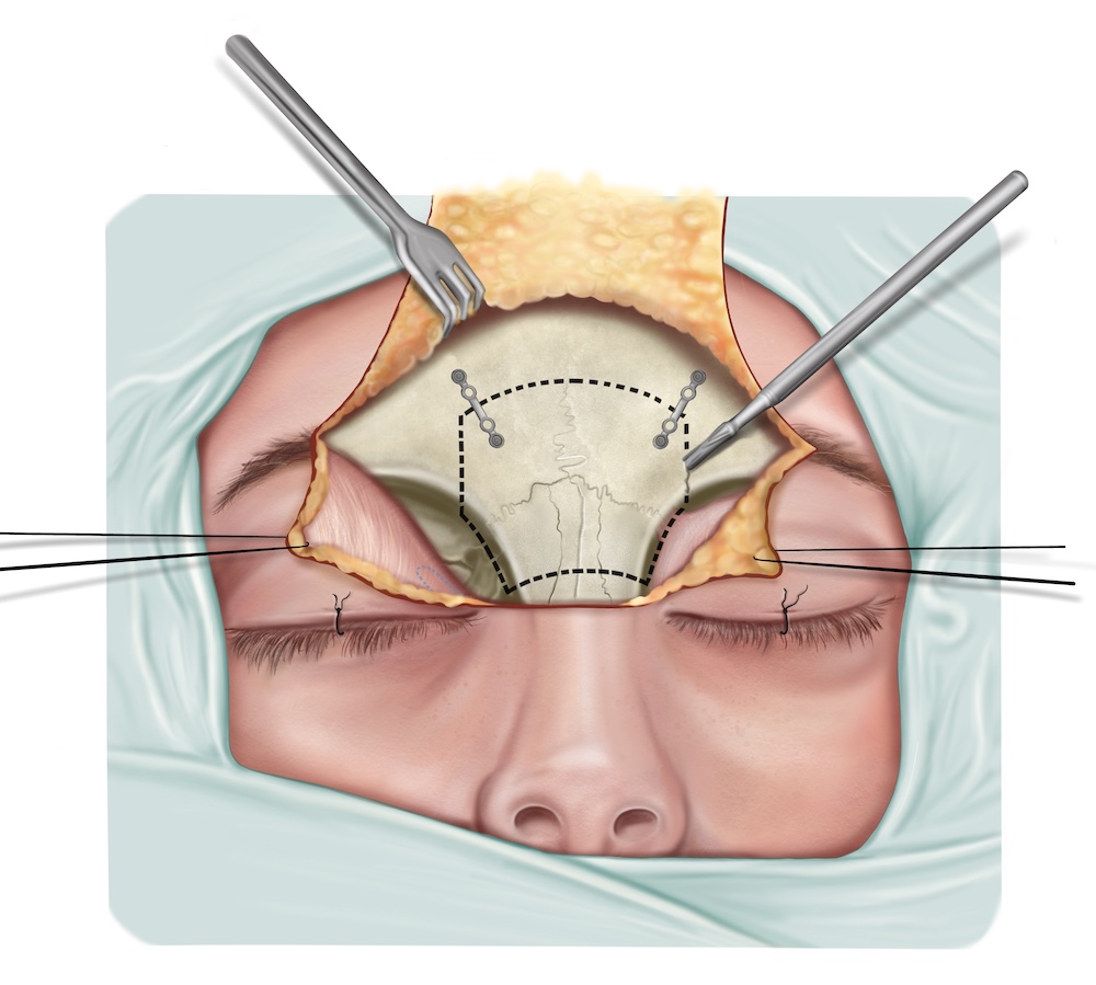 Surgical Atlas Illustration, Digital Illustration By Merlin Evans